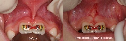 before and after frenectomy