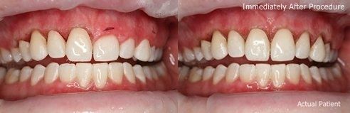 laser gum contouring before and after