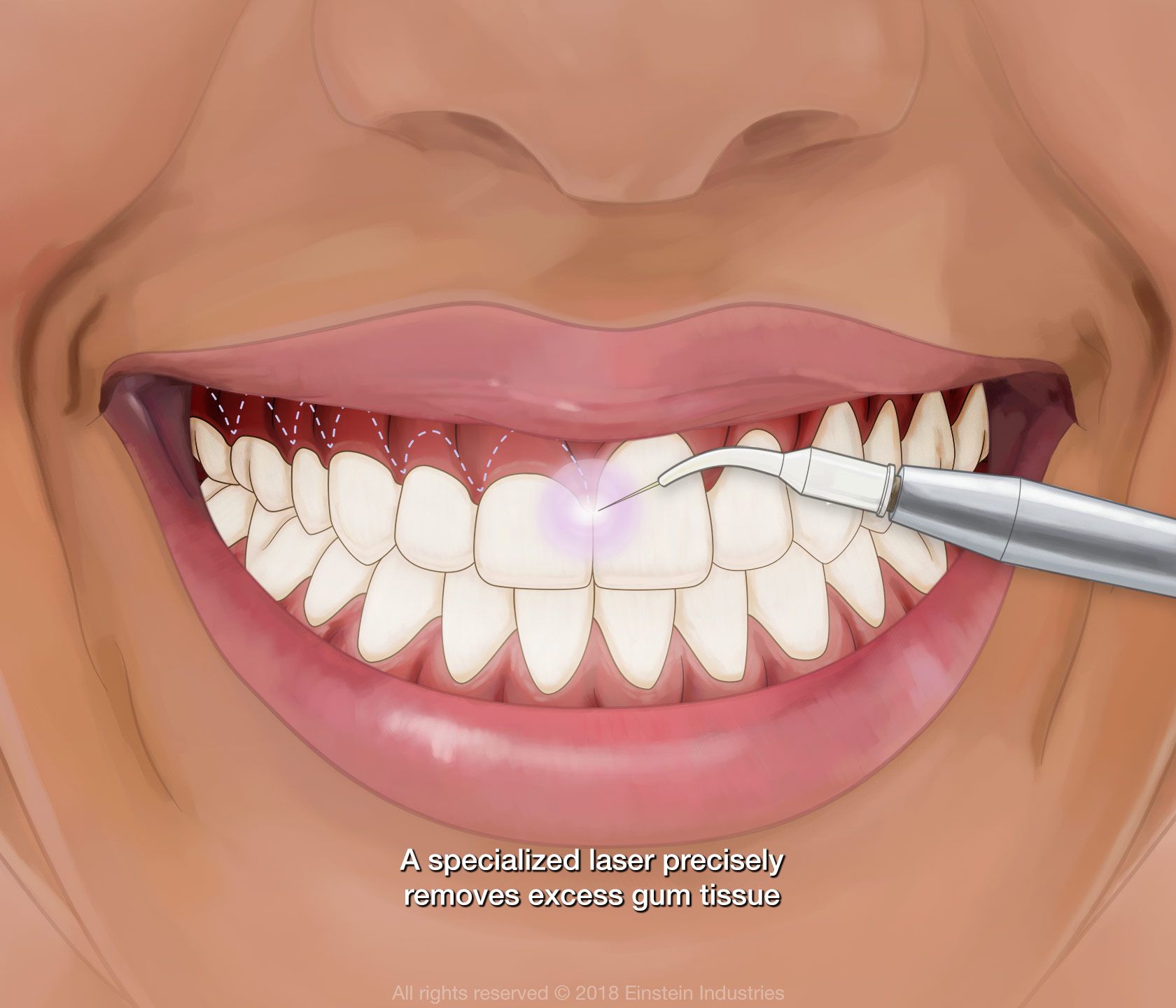 Laser gum surgery